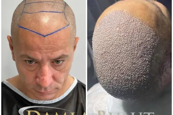 Damlabuluthairtrans Saç Ekim Kliniği - Resim 12
