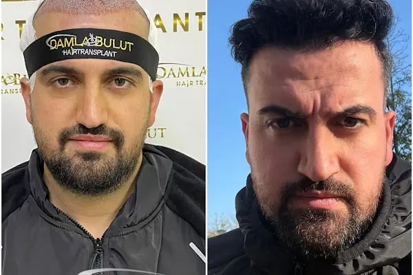 Damlabuluthairtrans Saç Ekim Kliniği - Resim 5