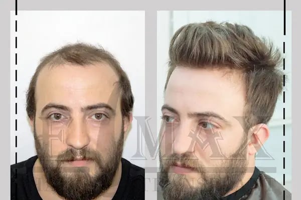 Emax hair - Resim 20