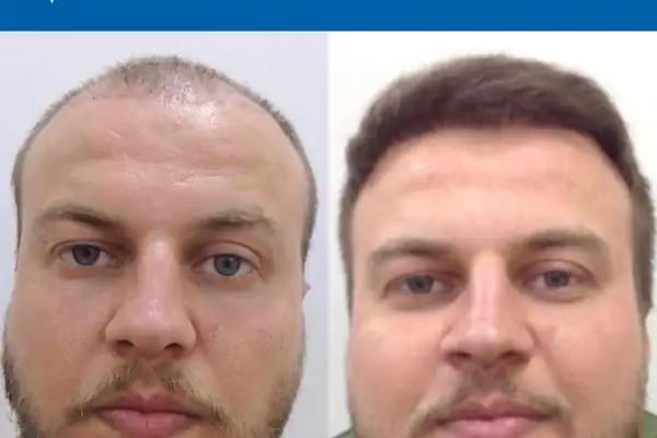 MEDAR Sakarya Saç Ekimi MEDARHAIR - Resim 16