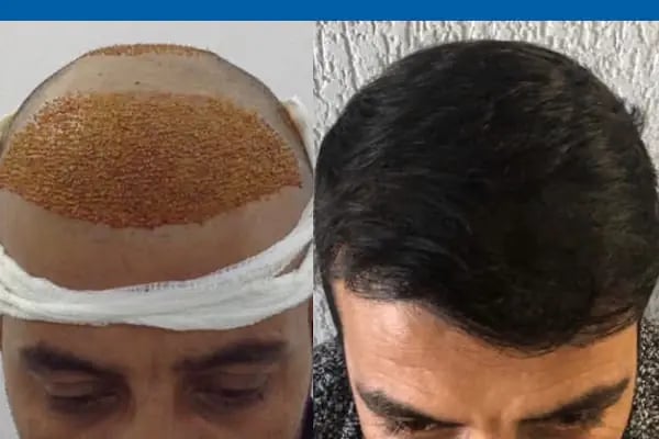 MEDAR Sakarya Saç Ekimi MEDARHAIR - Resim 15