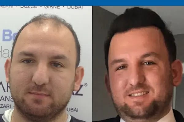 MEDAR Sakarya Saç Ekimi MEDARHAIR - Resim 14