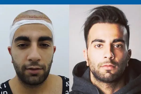 MEDAR Sakarya Saç Ekimi MEDARHAIR - Resim 13