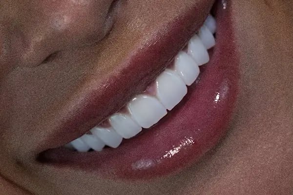 VDS Diş Kliniği Bağlar: Diş Çekimi, İmplant, Estetik Dolgu, Panoramik Röntgen, Lamine ve Zirkonyum Kaplama - Resim 19