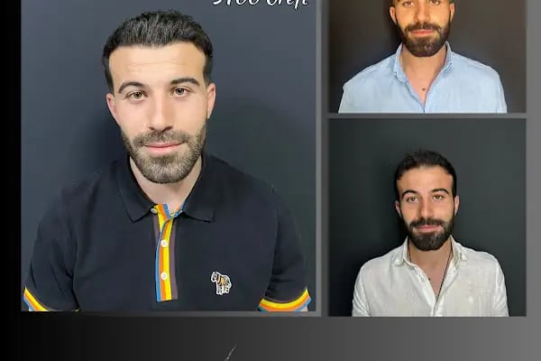 Ömer Uğur Saç Ekim - Resim 7