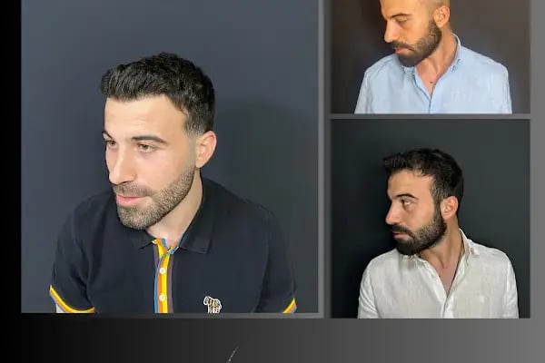 Ömer Uğur Saç Ekim - Resim 13