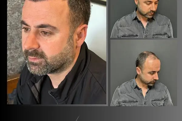 Ömer Uğur Saç Ekim - Resim 19