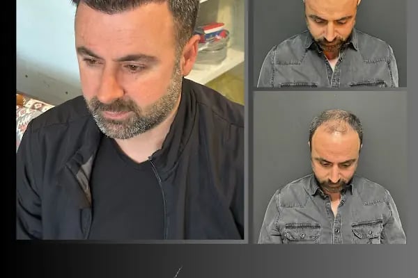 Ömer Uğur Saç Ekim - Resim 20