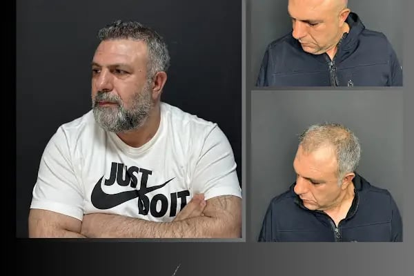 Ömer Uğur Saç Ekim - Resim 9