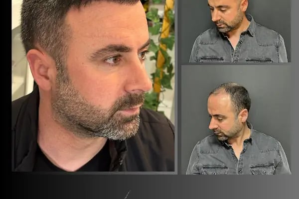 Ömer Uğur Saç Ekim - Resim 11