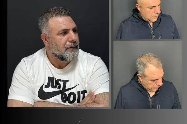 Ömer Uğur Saç Ekim - Resim 8