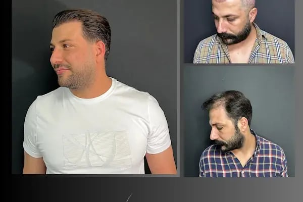 Ömer Uğur Saç Ekim - Resim 14