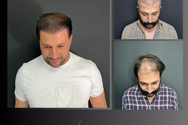 Ömer Uğur Saç Ekim - Resim 12