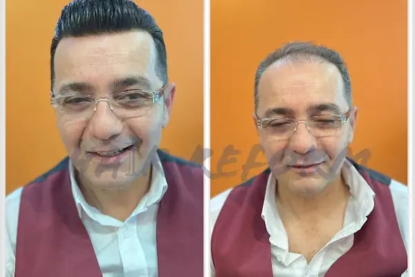ERAY FESLİGİL PROTEZ SAÇ ANTALYA - Resim 4
