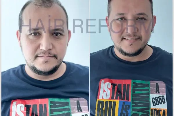 ERAY FESLİGİL PROTEZ SAÇ ANTALYA - Resim 8