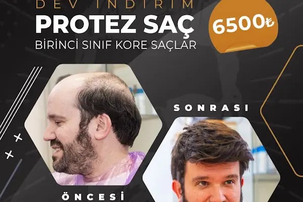 ERAY FESLİGİL PROTEZ SAÇ ANTALYA - Resim 5