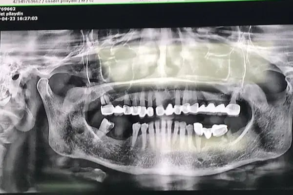 Mef Dental Grup - Malatya Diş Kliniği Şubesi - Resim 19