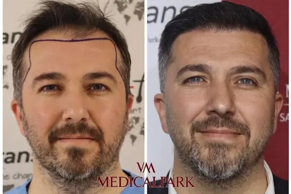 Hair Trans - İstanbul Saç Ekim Merkezi - Resim 6