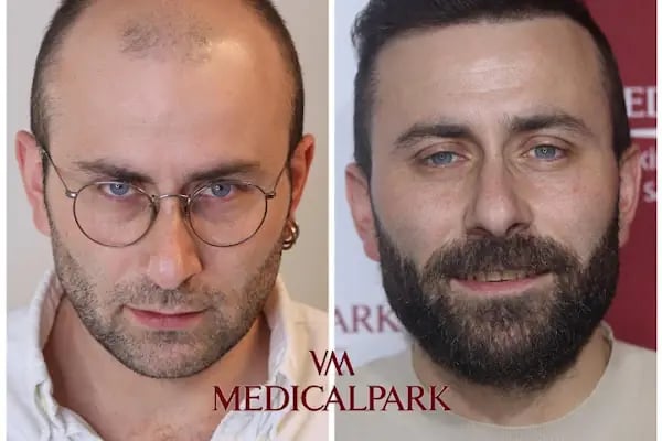 Hair Trans - İstanbul Saç Ekim Merkezi - Resim 3