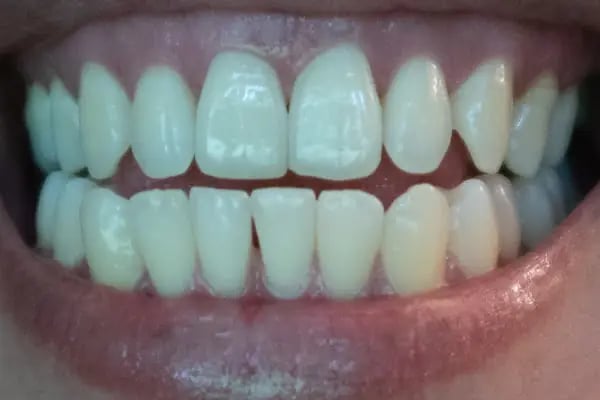 Diş Hekimi Sibel Özen Seyhan Adana Elmas Diş Kliniği - Resim 8
