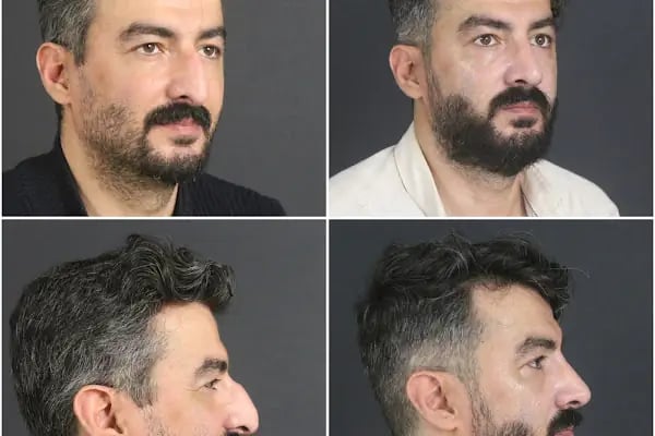 Op.Dr.Nurgül ALTUNTAŞ -Burun Estetiği, Rinoplasti, Meme Estetiği - Resim 18