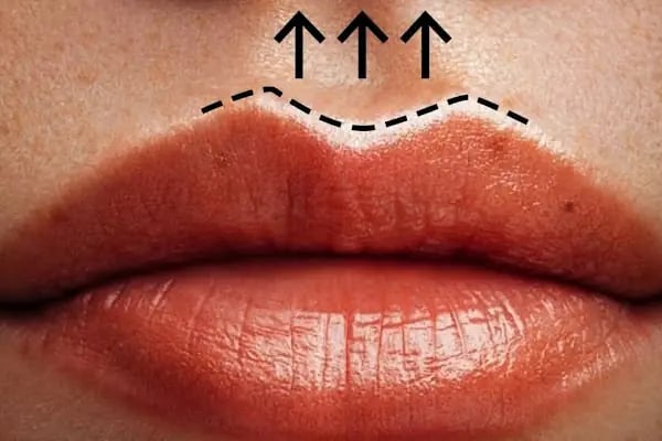 Plastderm - Resim 11