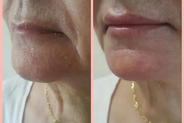 Plastderm - Resim 20