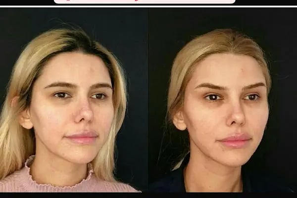 Plastderm - Resim 9