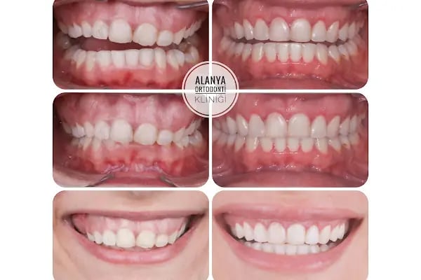 Alanya Ortodonti Kliniği Dr. İbrahim Kuzucu Dr. Kübra Kuzucu - Resim 3