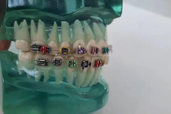Alanya Ortodonti Kliniği Dr. İbrahim Kuzucu Dr. Kübra Kuzucu - Resim 13