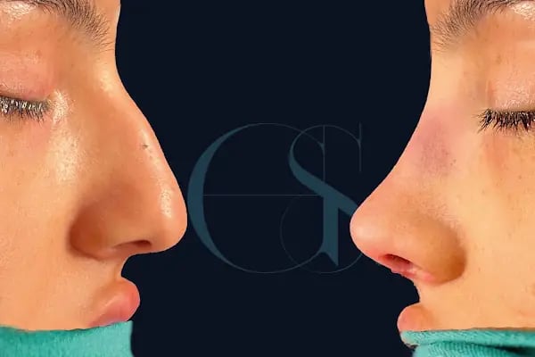 Dr Gökhan Semerci - Plastic Surgeon - Resim 3