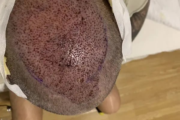 Antalya Hair Transplant Clinic OTEK | OTEK Hair Clinic - Resim 17