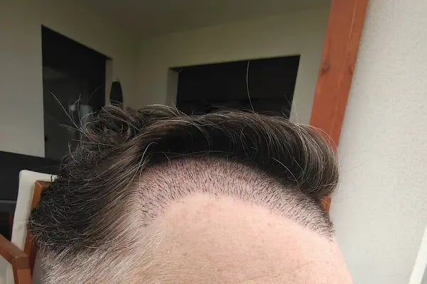 Antalya Hair Transplant Clinic OTEK | OTEK Hair Clinic - Resim 19