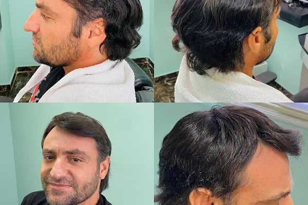 serkan cengiz protez saç merkezi adana - Resim 11