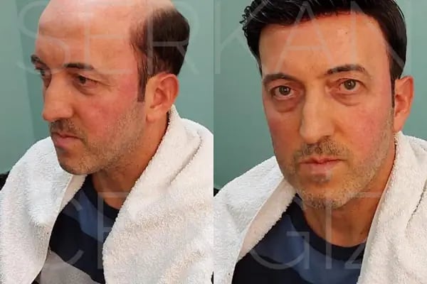 serkan cengiz protez saç merkezi adana - Resim 20