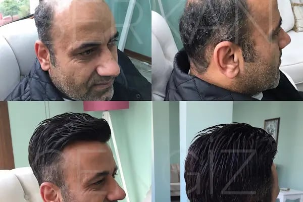 serkan cengiz protez saç merkezi adana - Resim 1