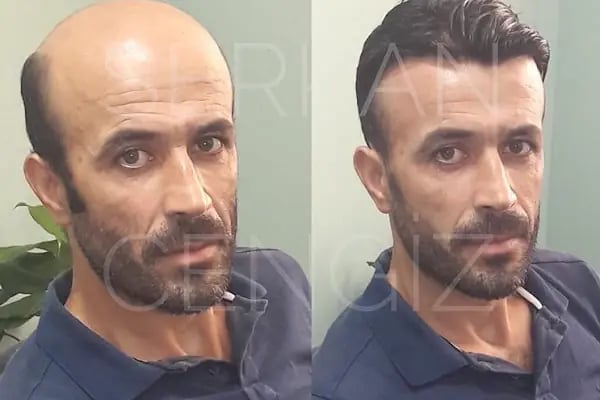 serkan cengiz protez saç merkezi adana - Resim 10