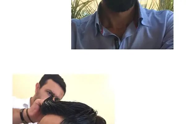 serkan cengiz protez saç merkezi adana - Resim 15