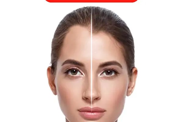 ExHairs - Samsun Saç Ekimi - Bafra Saç Ekimi - Resim 3