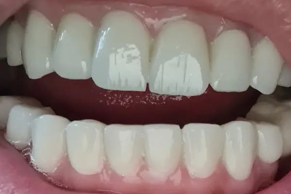 ÖZEL WESTDENT AĞIZ DİŞ HASTANESİ- Türkiye İzmir İmplant Diş Dent Clinic Türkey Dental İmplants in Turkey Zirconium in Turkey - Resim 13