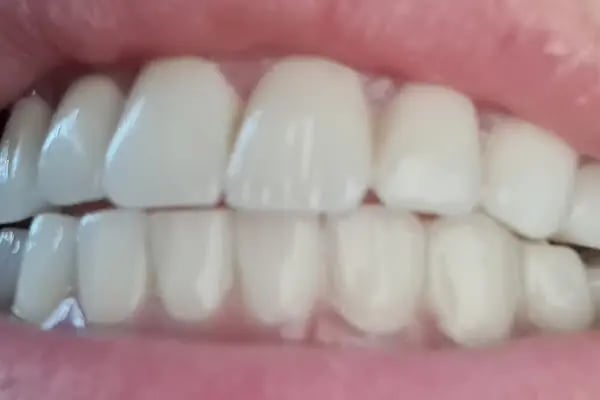 ÖZEL WESTDENT AĞIZ DİŞ HASTANESİ- Türkiye İzmir İmplant Diş Dent Clinic Türkey Dental İmplants in Turkey Zirconium in Turkey - Resim 19