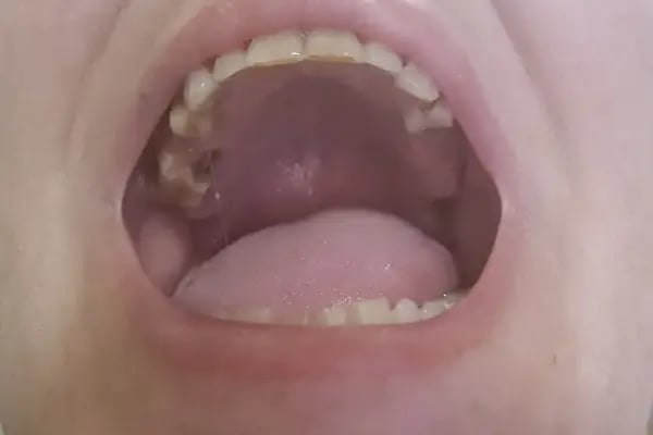 ÖZEL WESTDENT AĞIZ DİŞ HASTANESİ- Türkiye İzmir İmplant Diş Dent Clinic Türkey Dental İmplants in Turkey Zirconium in Turkey - Resim 16