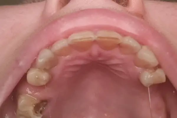 ÖZEL WESTDENT AĞIZ DİŞ HASTANESİ- Türkiye İzmir İmplant Diş Dent Clinic Türkey Dental İmplants in Turkey Zirconium in Turkey - Resim 20
