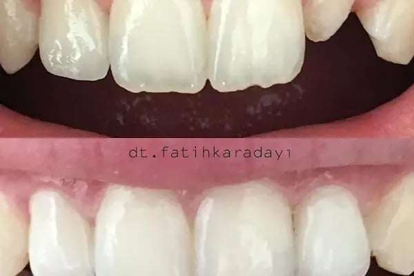 ÖZEL WESTDENT AĞIZ DİŞ HASTANESİ- Türkiye İzmir İmplant Diş Dent Clinic Türkey Dental İmplants in Turkey Zirconium in Turkey - Resim 18