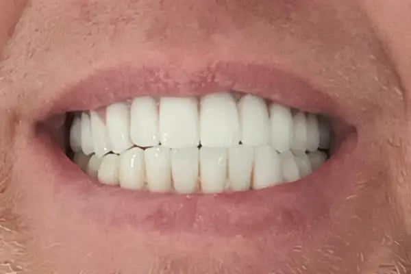 ÖZEL WESTDENT AĞIZ DİŞ HASTANESİ- Türkiye İzmir İmplant Diş Dent Clinic Türkey Dental İmplants in Turkey Zirconium in Turkey - Resim 14