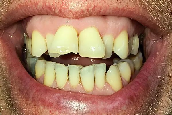 ÖZEL WESTDENT AĞIZ DİŞ HASTANESİ- Türkiye İzmir İmplant Diş Dent Clinic Türkey Dental İmplants in Turkey Zirconium in Turkey - Resim 3