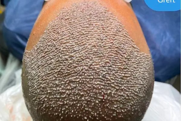 Clinic DHT | Saç Ekim Merkezi | Hair transplant | Dhi Saç Ekim Kliniği - Resim 7