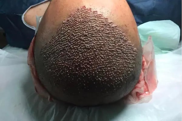 Clinic DHT | Saç Ekim Merkezi | Hair transplant | Dhi Saç Ekim Kliniği - Resim 16