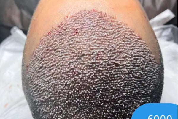 Clinic DHT | Saç Ekim Merkezi | Hair transplant | Dhi Saç Ekim Kliniği - Resim 9