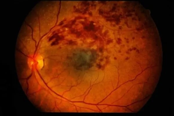 Prof. Dr. Yüksel Totan - Göz Doktoru - Retina Hastalıkları - Resim 20